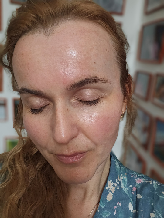 melasma pred po