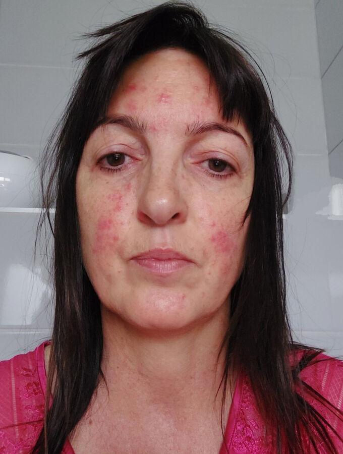 rosacea